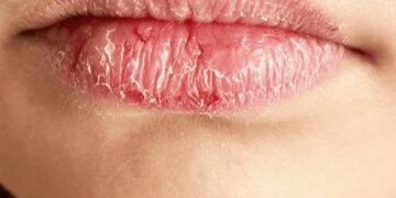 Топ-3 способи врятувати губи від пересихання і тріщин у мороз