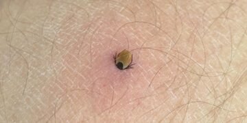 Кліщ вкусив: що робити одразу, а яких помилок уникати, щоб не нашкодити собі